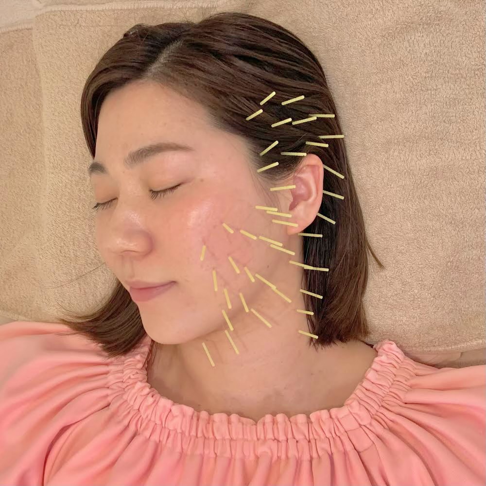 yuragi鍼灸院】くいしばり改善コース | 美容鍼灸のグラン治療院