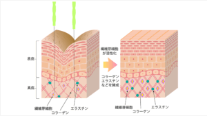 創傷治癒によるコラーゲン・エラスチンの産生（イメージ）