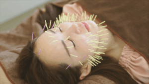 未来の美容鍼灸_光バイオ美鍼_11_お顔と頭部に美容鍼