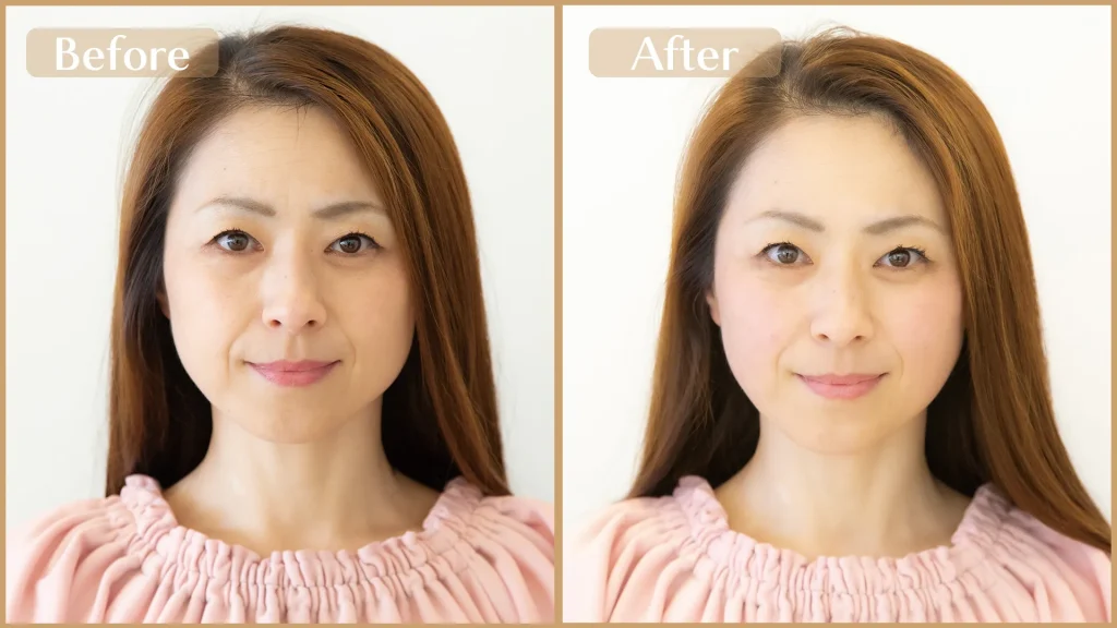 美容鍼灸で目が大きく眼瞼下垂