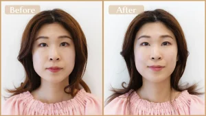 美容鍼灸 ビフォアアフター写真（フェイスラインがすっきりする・小顔効果）