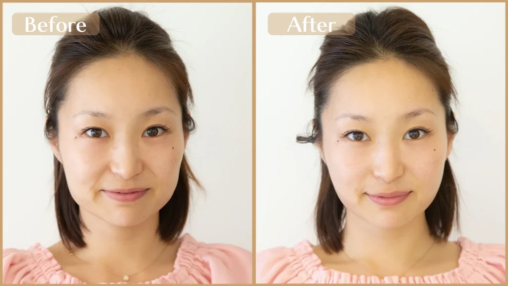 美容鍼でリフトアップ