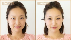 美容鍼でリフトアップ