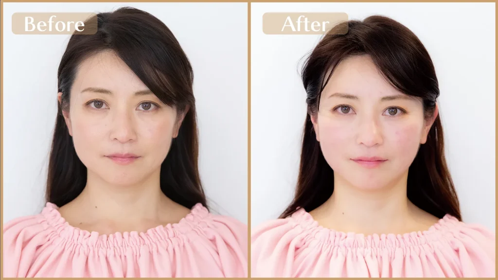 美容鍼灸で小じわ・ほうれい線ケア