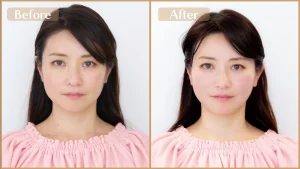 美容鍼灸で小じわ・ほうれい線ケア